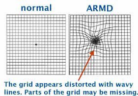 Two amsler grids demonstrating normal versus Age Related Macular Degeneration. The Grid appears distorted with wavy lines. Parts of the grid may be missing.