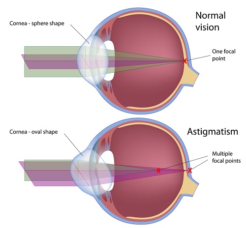 Chart showing an eye with astigmatism