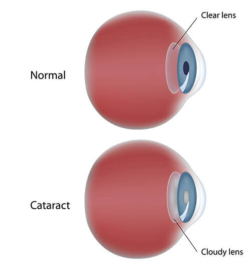 Chart showing what a cataract is