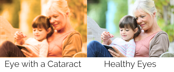 Chart showing what your sight looks like when you have a cataract