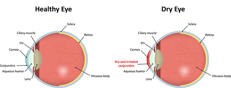 Chart showing a healthy eye vs one with dry eye