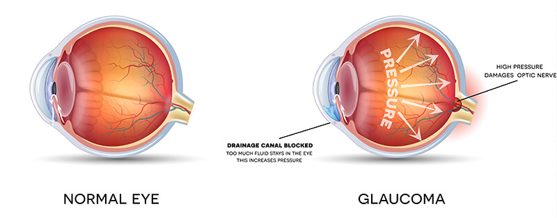 Chart showing a healthy eye vs one with glaucoma