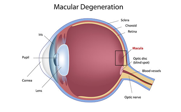 Chart showing an eye with macular degeneration