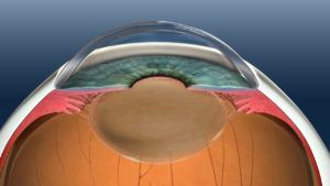 Eye pre cataract surgery