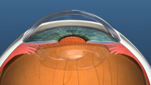 Cataract Surgery with an IOL in place